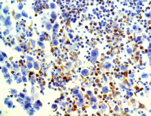 IHC of LAG-3 on a FFPE Testicular Carcinoma Tissue